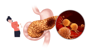 pancreas cancer
