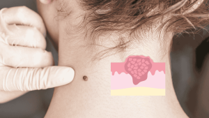 skin-tags-removal-dangers